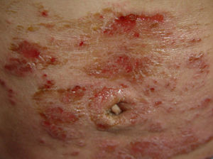 皮肤湿疹的症状图片有哪些?